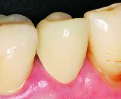 Готовый зубной протез из пластмассы Luxatemp Star